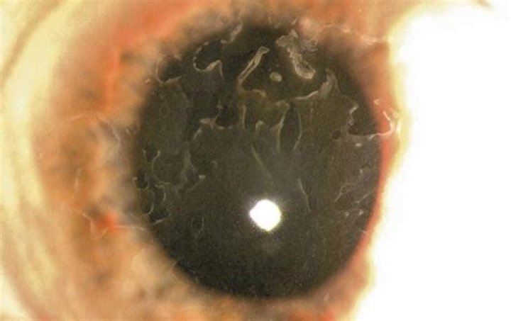 anterior basement membrane dystrophy