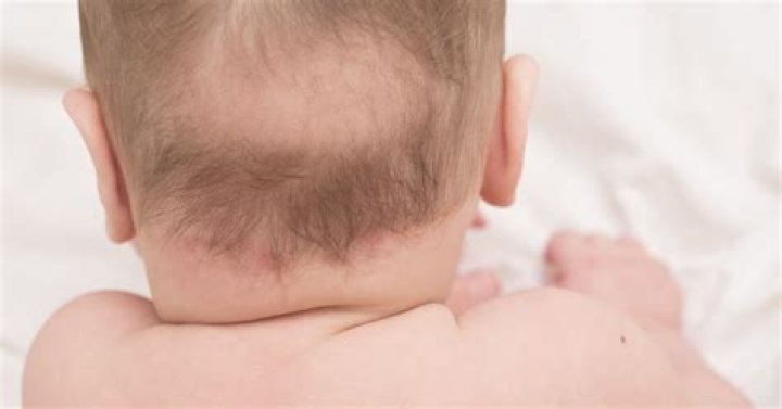 baby bald spot