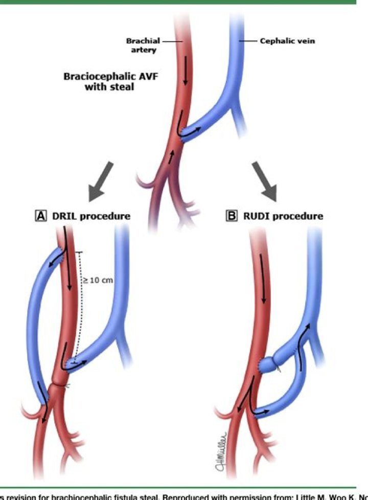 brachiocephalic fistula