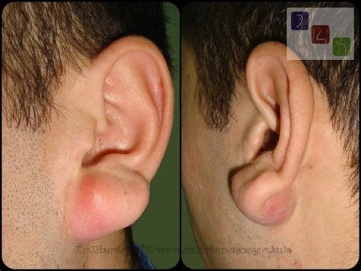 cyst on earlobe