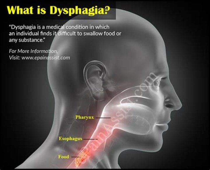 esophageal dysphagia icd 10