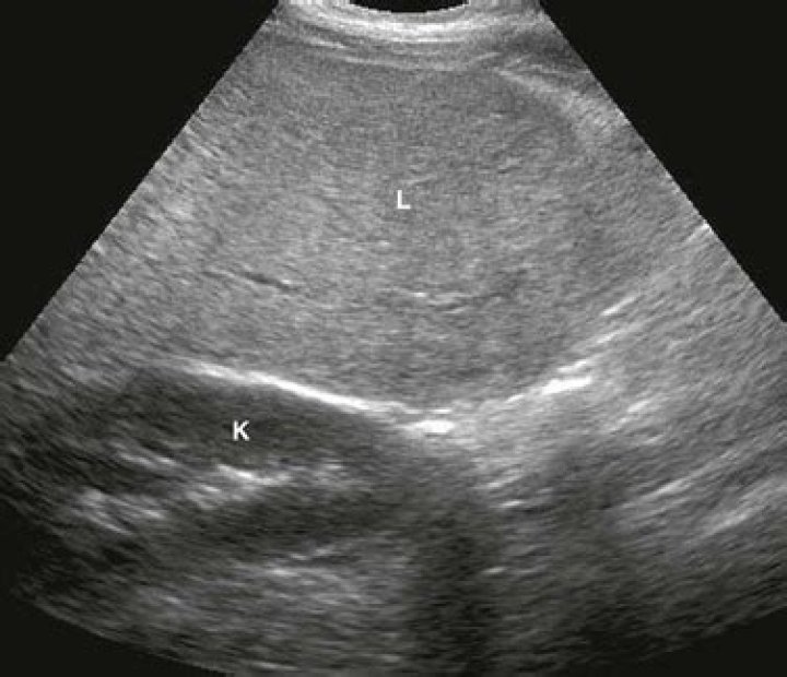 hepatic parenchymal disease