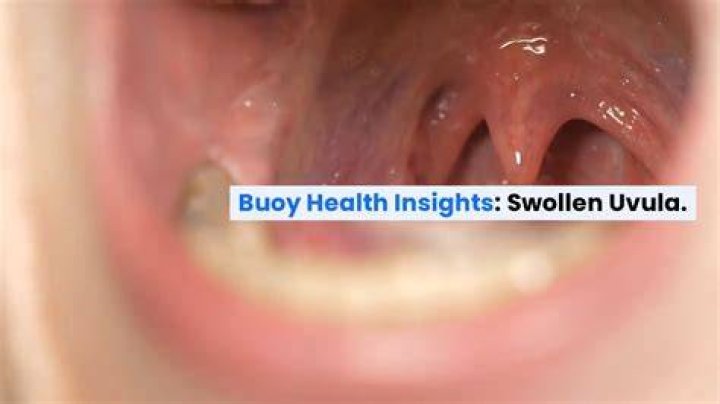 how long does a swollen uvula last