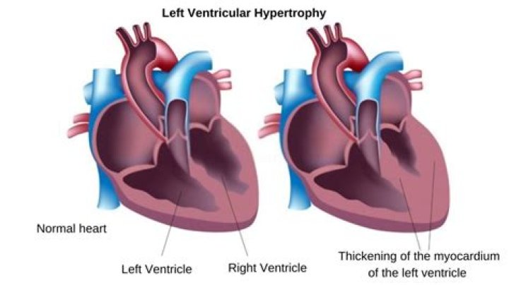 icd 10 code for left ventricular hypertrophy