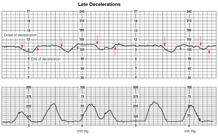 late decelerations causes