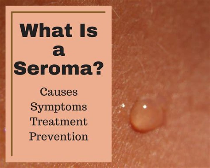 seroma symptoms