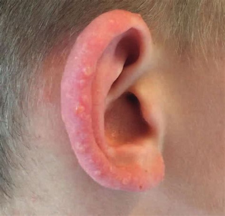 small bumps on ears